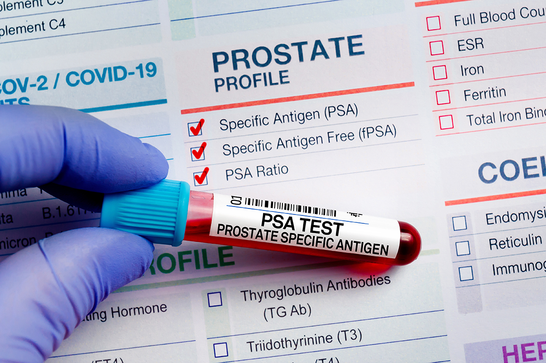 Prostate Cancer: Why Black Men Should be Screened